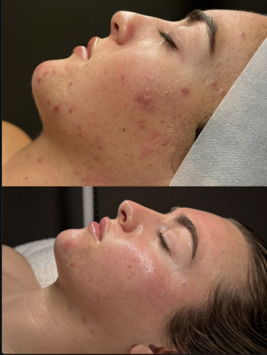 Hydrafacial