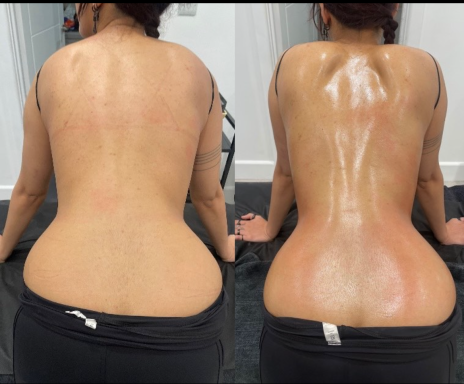 360 Lipo