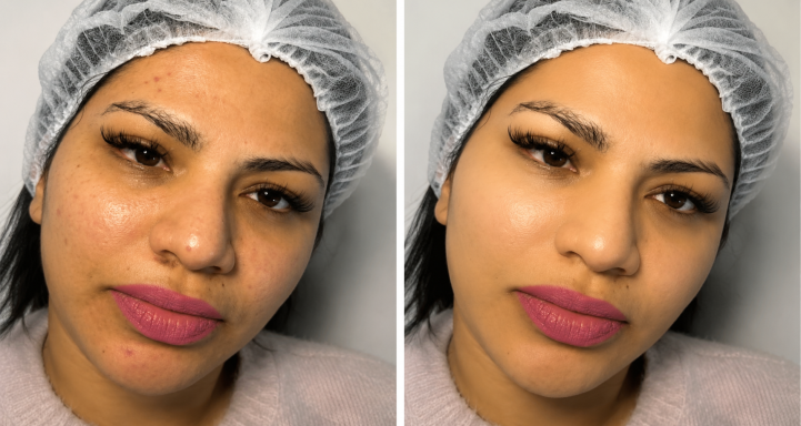 Microneedling